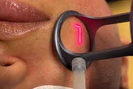 Laser CO2 Fractional RF Technician training at BC Medical Spa & Wellness Centre